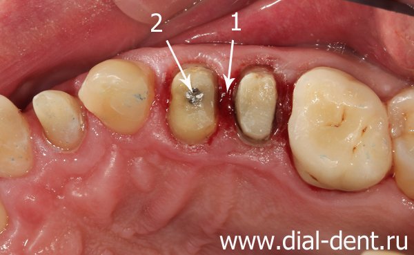 вид зубов после снятия коронок