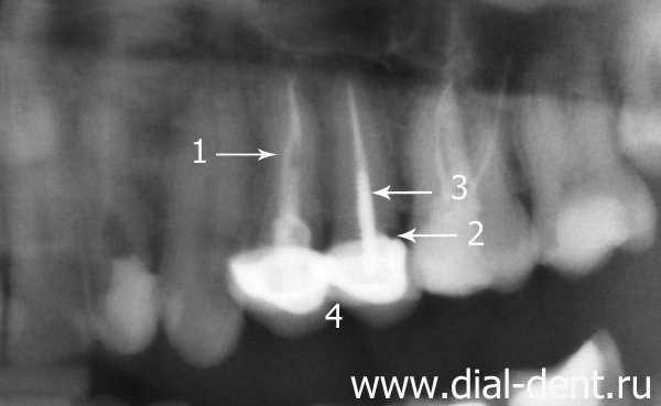 фрагмент панорамного снимка зубов