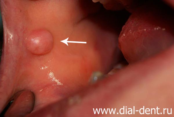 фиброма слизистой рта