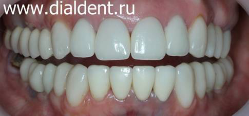 комплексная реставрация зубов от Диал-Дент