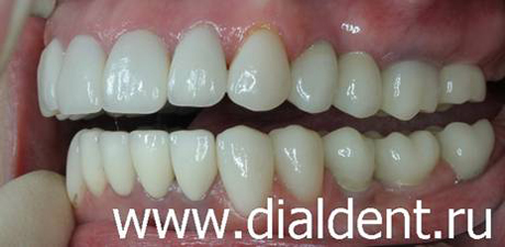 вид слева после лечения и протезирования зубов в Диал-Дент