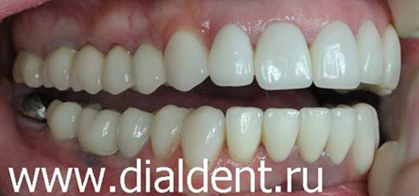 вид справа после лечения и протезирования зубов в Диал-Дент