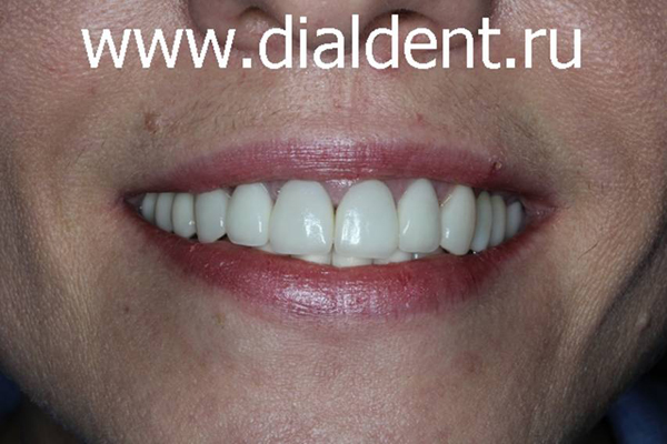 улыбка после комплексного лечения и протезирования зубов в Диал-Дент