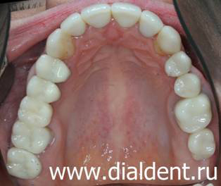 верхние зубы после лечения и протезирования зубов в Диал-Дент