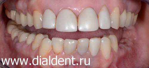 проблемные зубы и старые зубные протезы