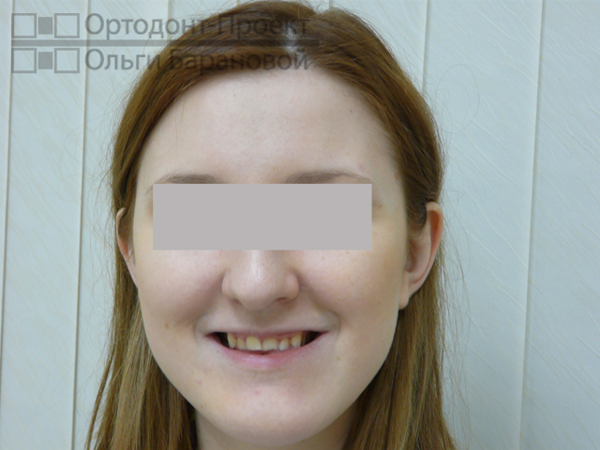 улыбка до лечения у ортодонта