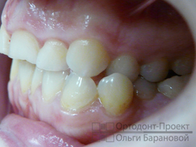 вид слева до лечения у ортодонта
