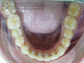 нижние зубы после лечения у ортодонта