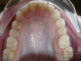 верхние зубы после лечения у ортодонта