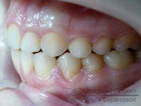 вид слева результат ортодонтического лечения