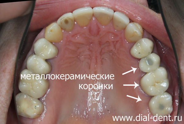 верхние зубы после протезирования на имплантах