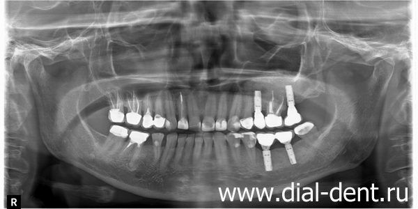панорамный снимок зубов после удаления зубов, перелечивания зубных каналов, имплантации зубов и протезирования