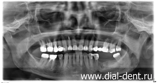 панорамный снимок зубов после удаления нижнего зуба