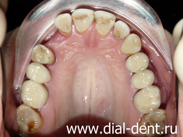 окончание ортодонтического лечения для подготовки к протезированию зуба