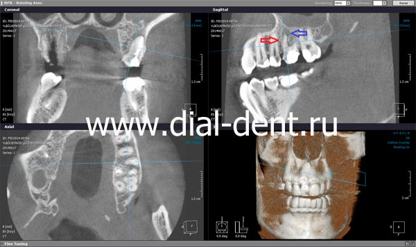 компьютерная томография зубов до лечения - пропущен канал в зубе, есть воспаление у корня