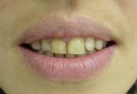 улыбка до реставрации зубов