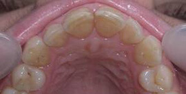 Вид жевательной поверхности до лечения зубов