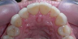 Вид жевательной поверхности после лечения зубов в клинике Диал-Дент