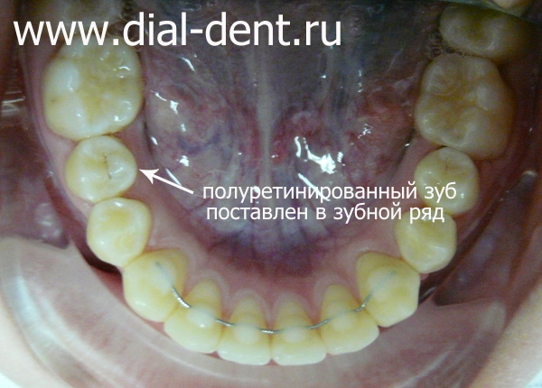 результат лечения - сохраненный зуб и ровный зубной ряд