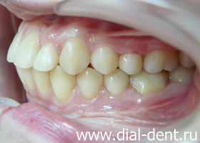 результат ортодонтического лечения вид слева