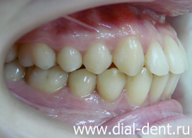 результат ортодонтического лечения вид справа