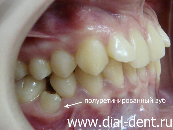 полуретинированный зуб, криво растущие зубы