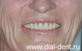 улыбка после протезирования зубов в Диал-Дент·