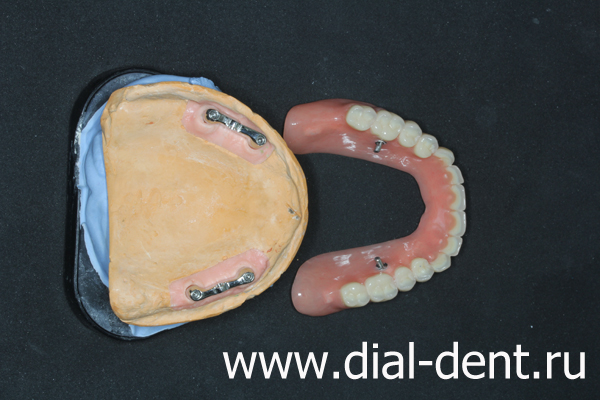 съемный протез зубов верхней челюсти с креплением на импланты