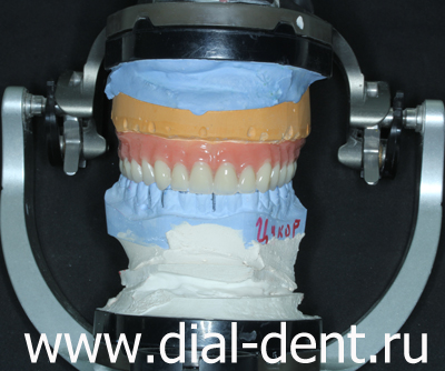 изготовление зубных протезов в Диал-Дент