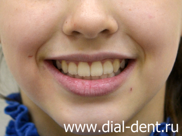 результат ортодонтического лечения в Диал-Дент