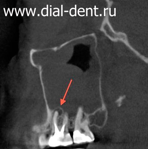 воспаление у корня зуба, проблемы в гайморовой пазухе