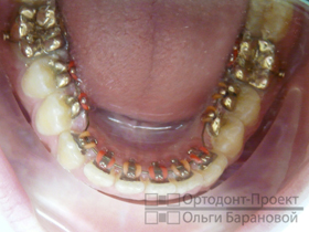 брекеты Incognito на нижних зубах через 4 месяца