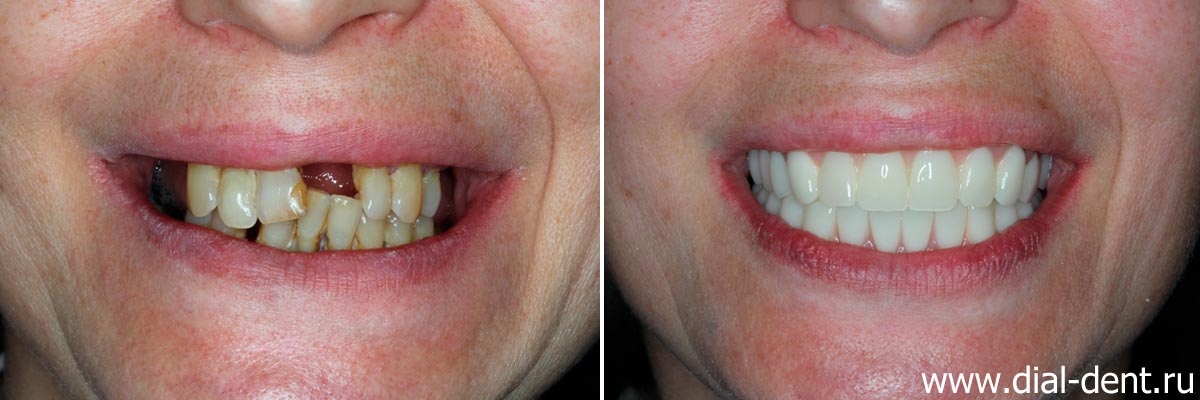 улыбка до и после протезирования зубов