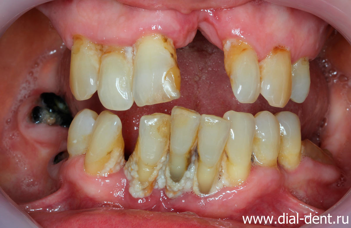 пародонтит, отсутствие зубов до лечения в Диал-Дент