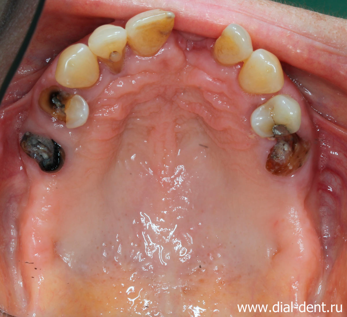 пародонтит, отсутствие зубов - верхняя челюсть до лечения