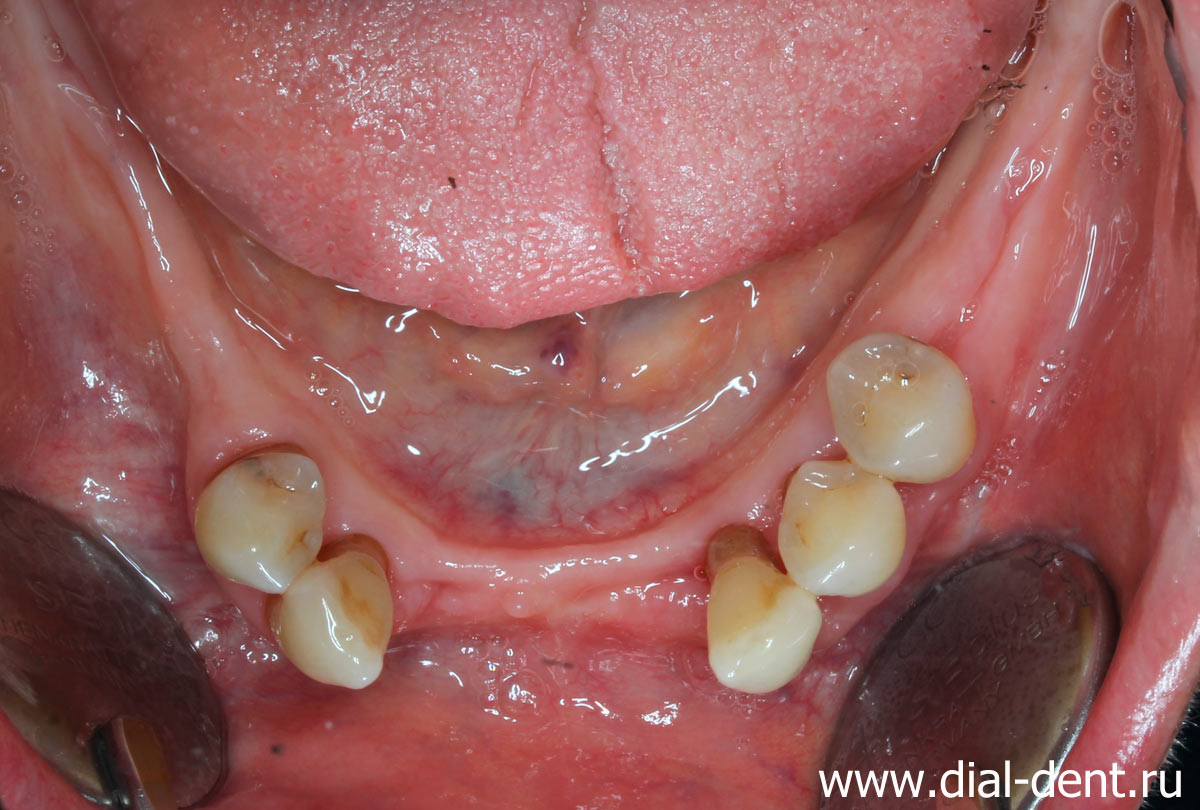 выполнено удаление зубов и лечение пародонтита лазером - нижняя челюсть
