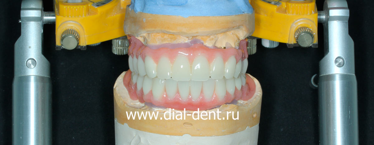 моделирование зубных протезов в Диал-Дент