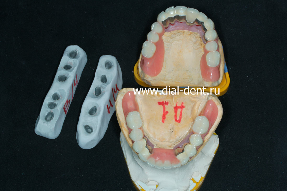 моделирование зубных протезов в Диал-Дент