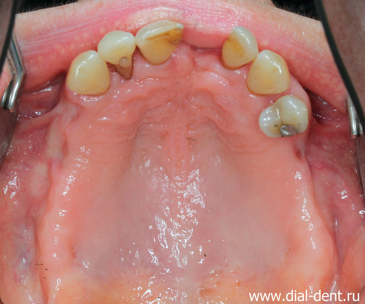 выполнено удаление зубов и лечение пародонтита лазером - верхняя челюсть