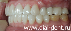 вид зубов слева после реставрации и протезирования
