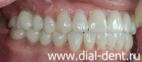 вид зубов справа после реставрации и протезирования