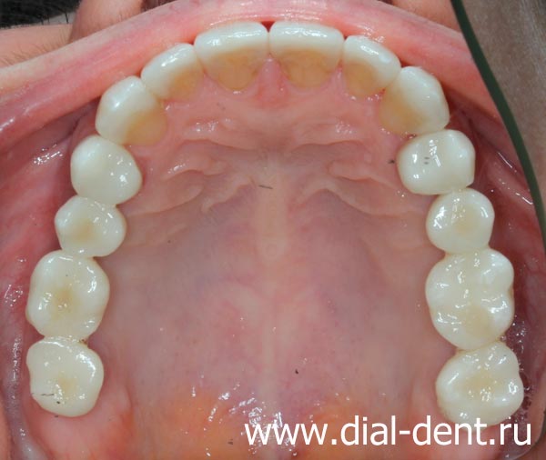 вид зубов верхней челюсти после протезирования и реставрации