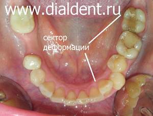 нижние зубы при обращении