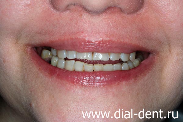 улыбка до лечения и протезирования зубов