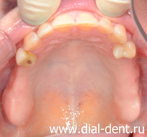 верхняя челюсть после удаления разрушенного зуба