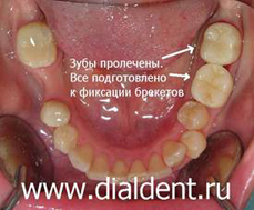 зубы подготовлены к ортодонтическому лечению