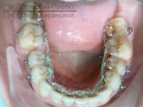 нижние зубы через два года лечения брекетами Инкогнито