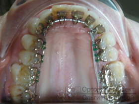 верхние зубы через два года лечения брекетами Инкогнито