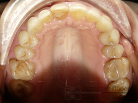 верхние зубы после лечения