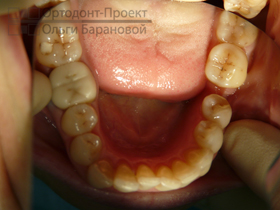 нижние зубы до лечения